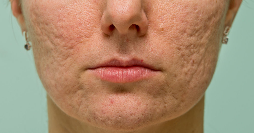 Journal of Aesthetic Nursing - Reflecting on acne scarring for